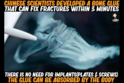 Chinese scientists develop bone glue for rapid fracture repair