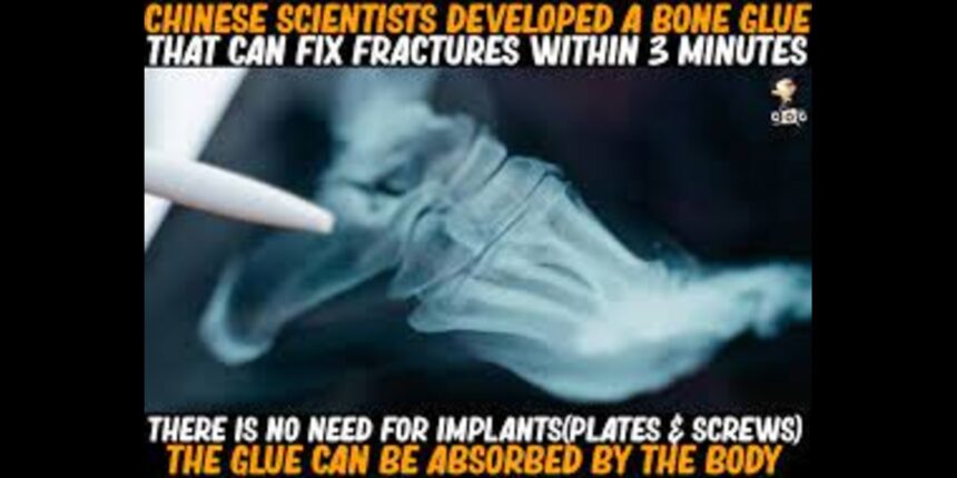 Chinese scientists develop bone glue for rapid fracture repair