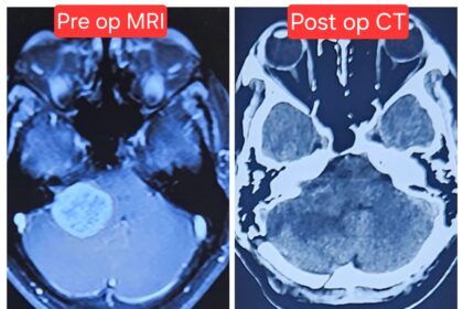 Timely Brain Surgery Saves 25-Year-Old from Life-Threatening Complications at CARE Hospitals, Malakpet