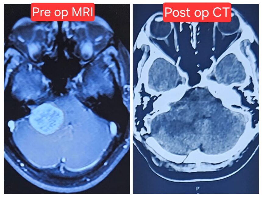 Timely Brain Surgery Saves 25-Year-Old from Life-Threatening Complications at CARE Hospitals, Malakpet